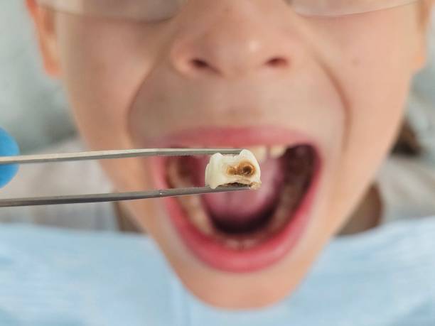 Best Emergency Root Canal Therapy in Oak Harbor, WA